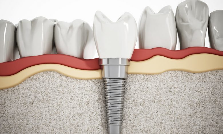 price of dental implants