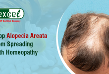 Homeopathic Medicine for Alopecia Areata