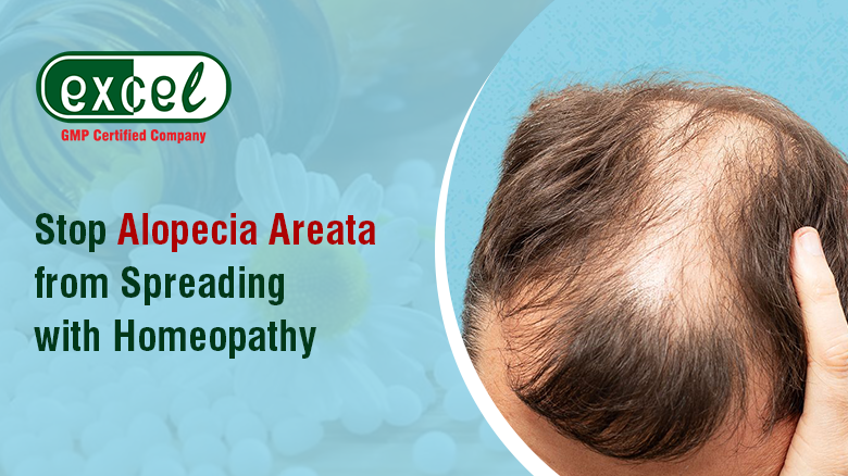 Homeopathic Medicine for Alopecia Areata