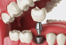 dental-implant-teeth