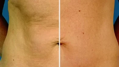 Skin Tightening Stomach